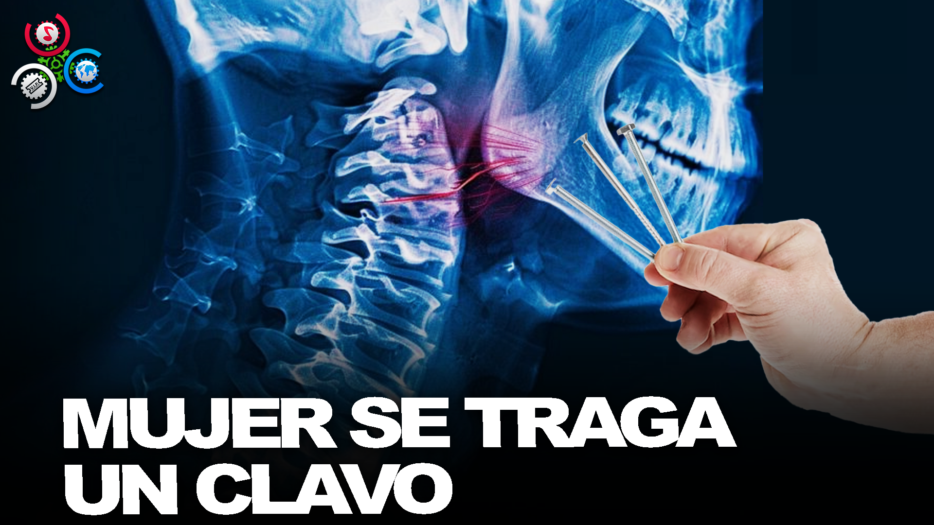 Mujer Se Traga Un Clavo Y Se Le Va A La ARTERIA CARÓTICA