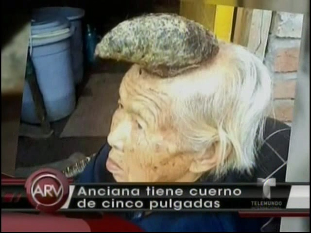 Anciana Le Sale Un Cuerno De Cinco Pulgadas En La Cabeza Después De Estar Tratando Un Lunar Extraño Con Un Remedio Casero #Video