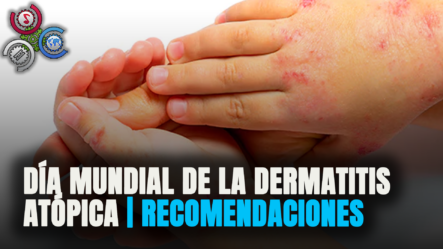 Día Mundial De La Dermatitis Atópica | ¿Como Saber Si Sufro De Dermatitis?