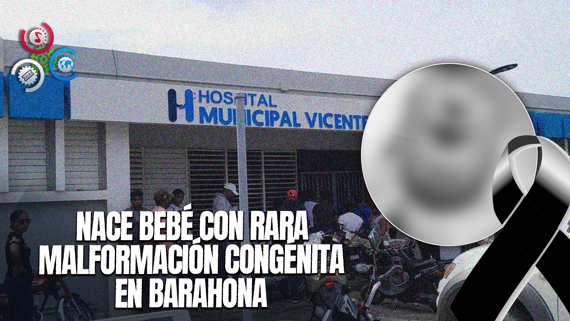 Bebé Nace Supuestamente Con ‘un Solo Ojo’ En Barahona; Fallece Poco Después Del Nacimiento