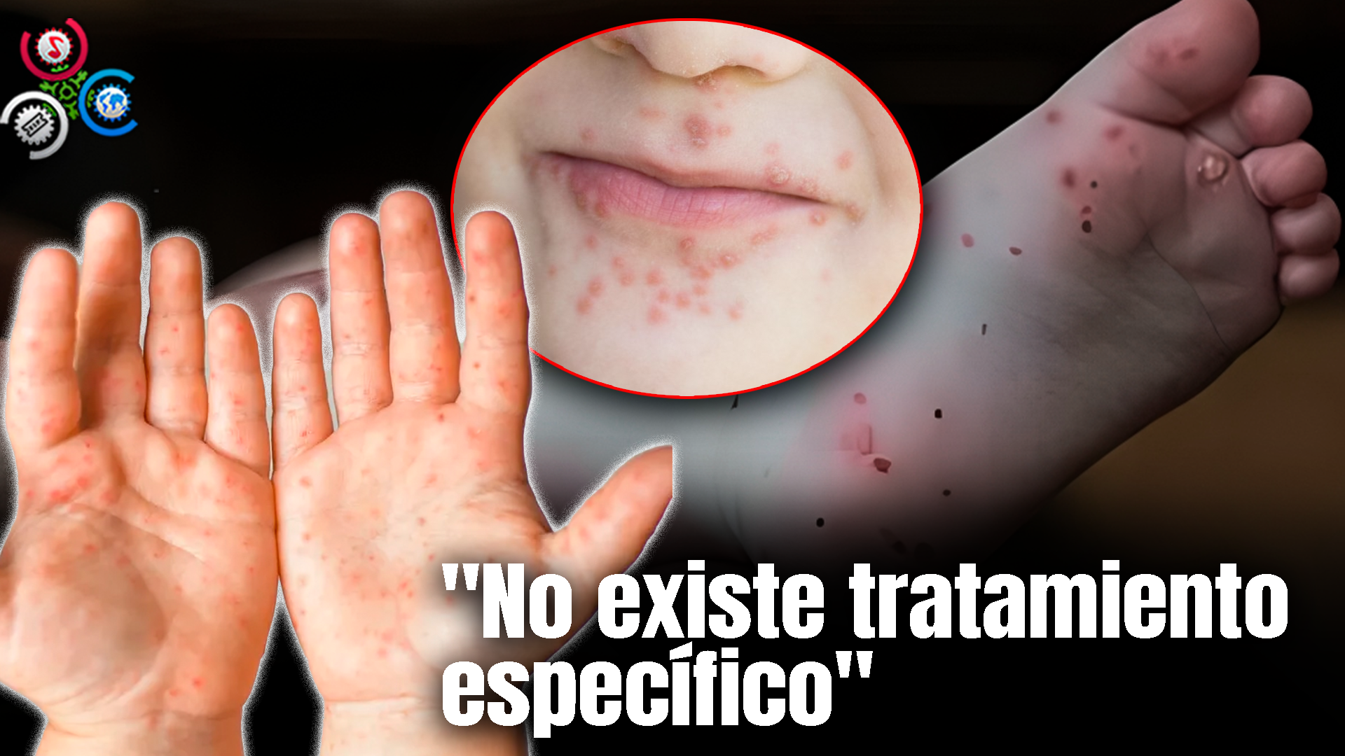 Alertan Sobre Casos De La Enfermedad De Manos, Pies Y Boca