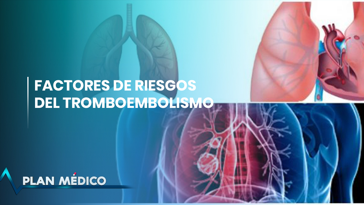 Tromboembolismo: ¿Por Qué Un Coágulo De Sangre Te Puede Matar? | Plan Médico (2/2)