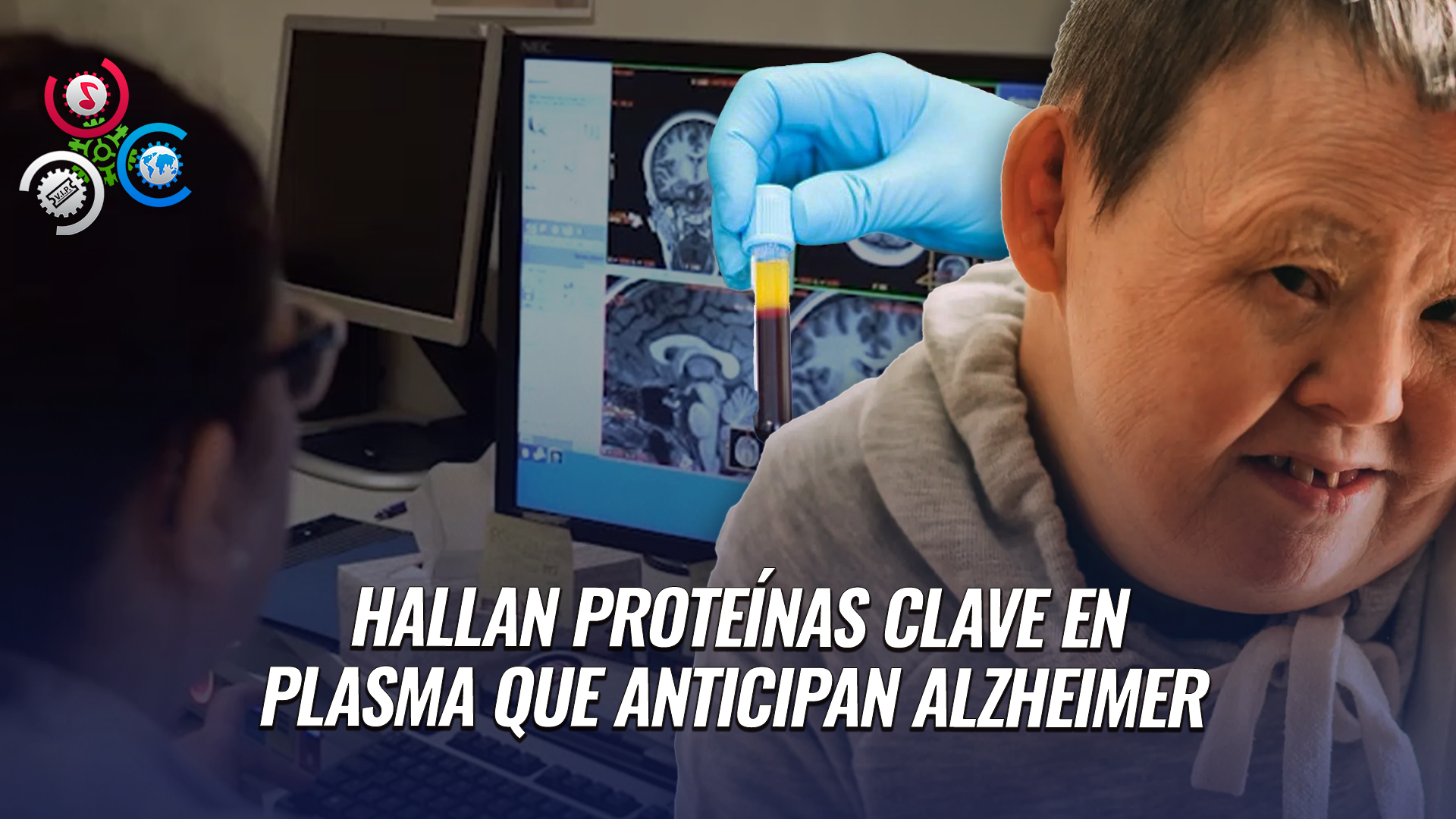 Una Prueba De Sangre Podría Anticipar El Alzheimer En Personas Con Síndrome De Down
