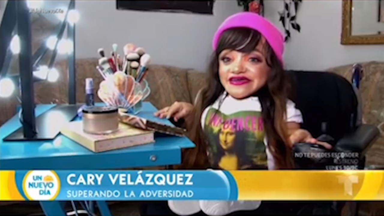 Cary Velázquez, Padece Osteogénesis Imperfecta Conocida Como “Huesos De Cristal”