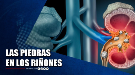 Dr. Domingo Martínez Habla Sobre Las Piedras En Los Riñones | Tu Tarde
