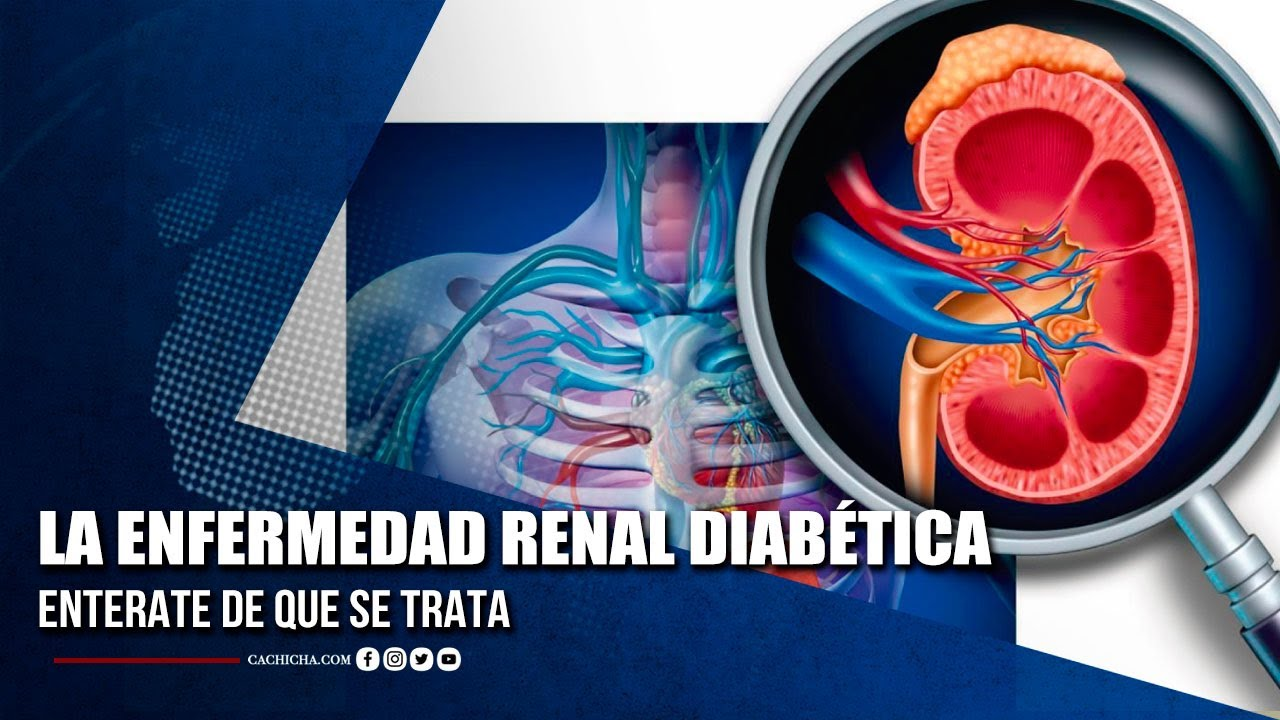 ¿Qué Es La Enfermedad Renal Diabética? | Tu Tarde