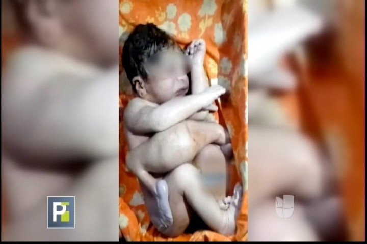 En India Nace Un Bebe Con Mal Formación De “gemelo Parasito” Y Sorprende A Todos