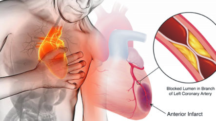 Conocemos Todo Lo Relacionado A La Isquemia Cardiaca