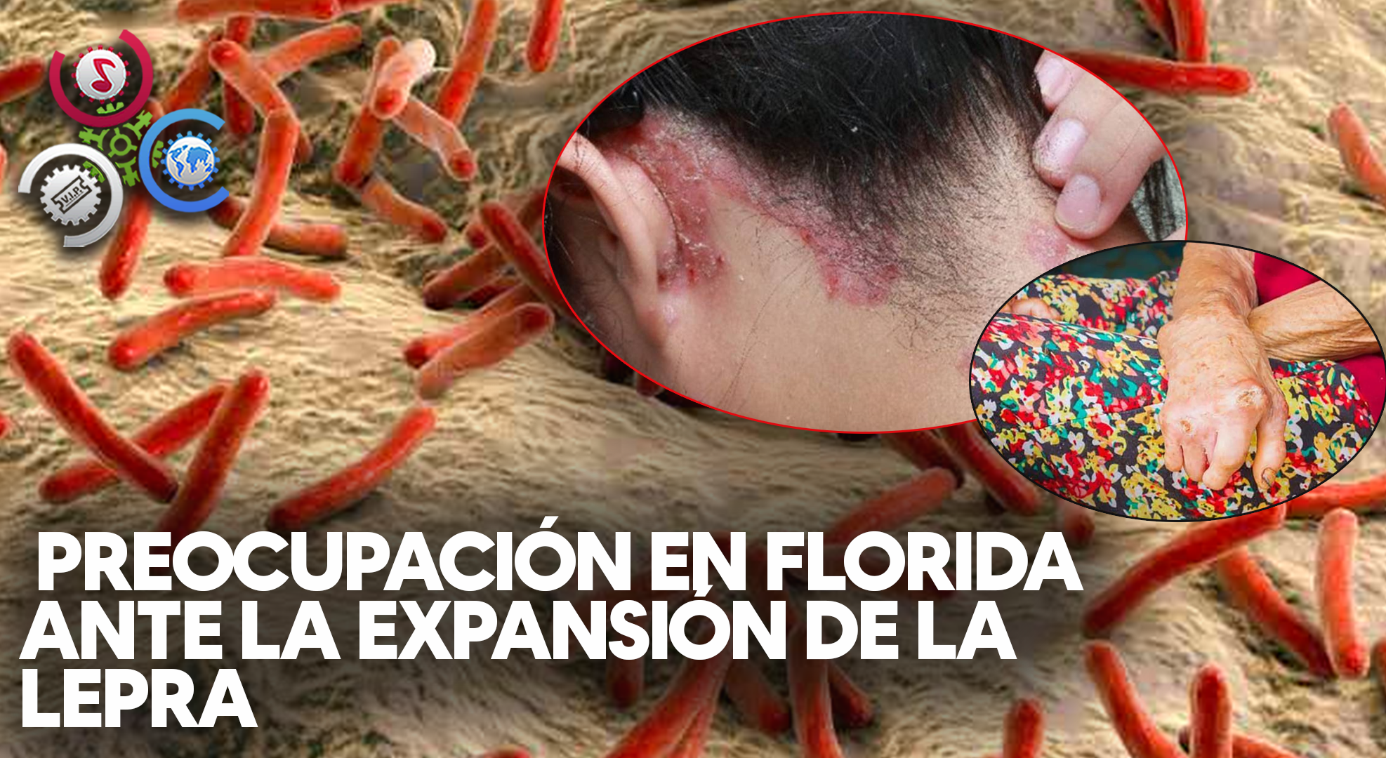 Hay Preocupación En Florida Ante La Expansión De La Lepra