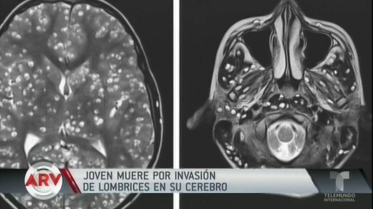 Joven Muere Por Invasión De Lombrices En Su Cerebro