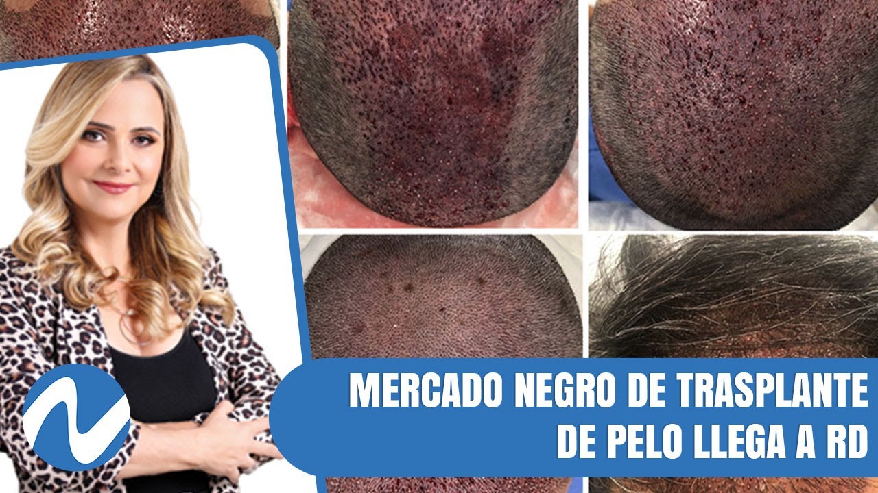 Mercado Negro De Trasplante De Pelo Llega A RD | Nuria Piera