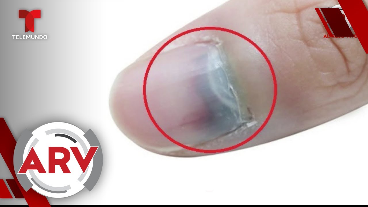 Cáncer En Las Uñas Podría Confundirse Con Un Golpe Y Revelan Cómo Detectarlo