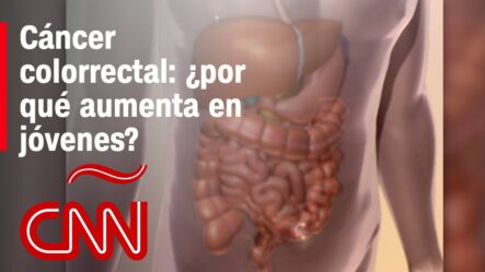 Aumento De Casos Del Cáncer Colon En Jóvenes | ¿A Qué Se Debe Y cómo Ayudar A Prevenir? 