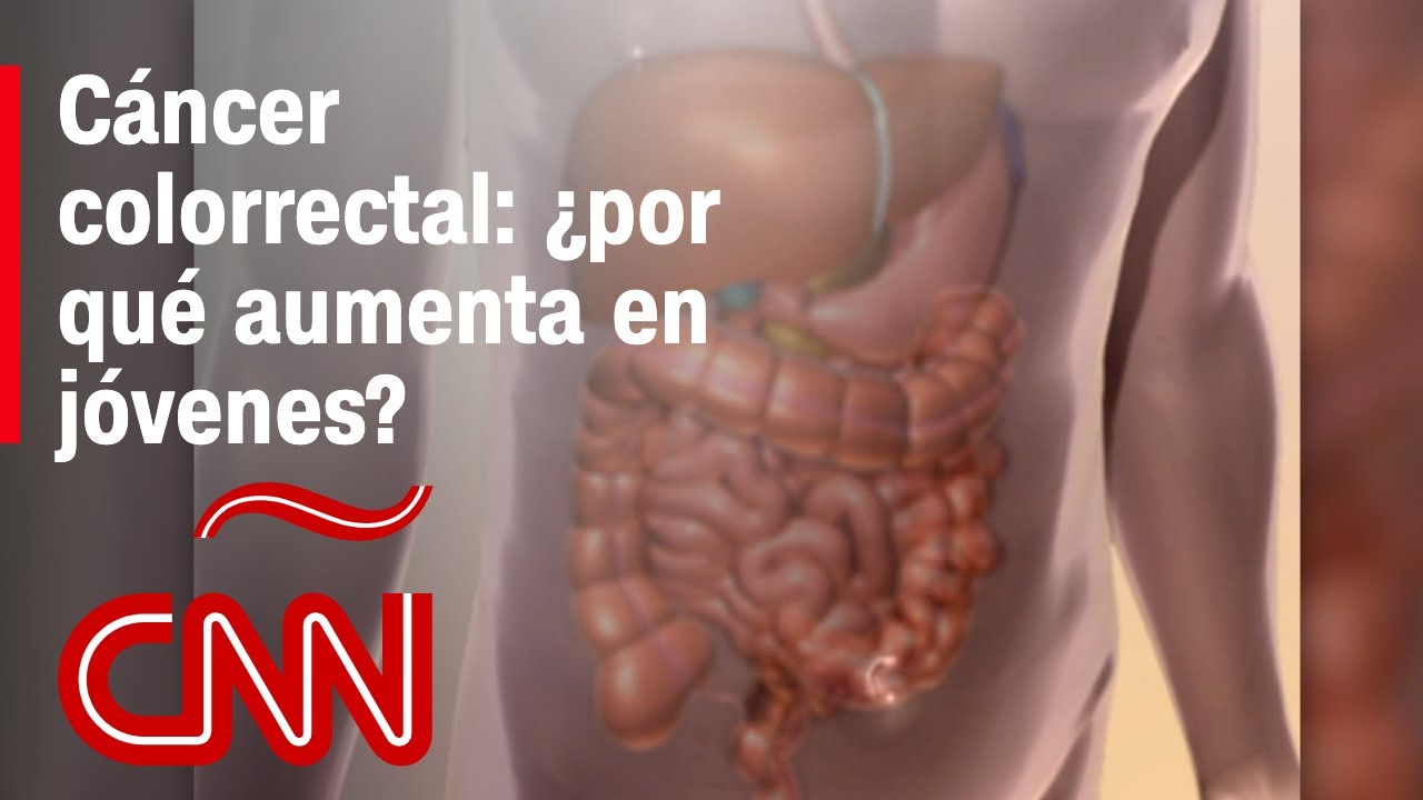 Aumento De Casos Del Cáncer Colon En Jóvenes | ¿A Qué Se Debe Y cómo Ayudar A Prevenir? 