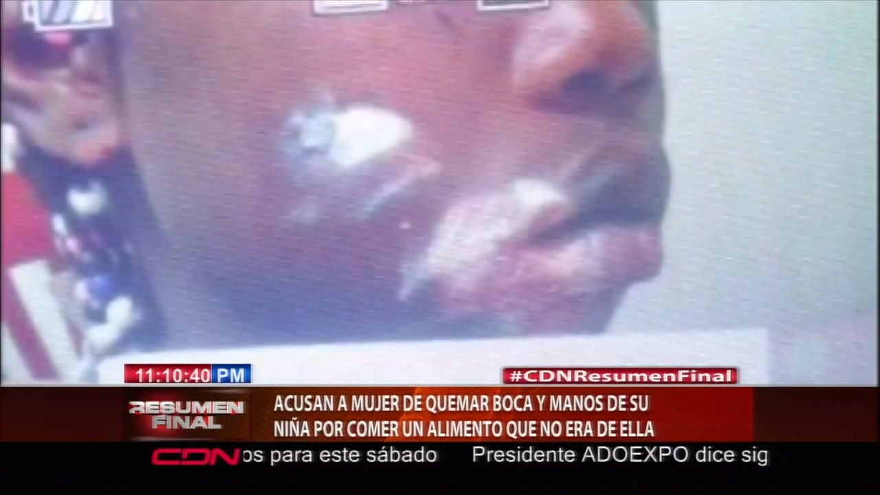 Acusan A Mujer De Quemar Boca Y Manos De Su Niña Por Comer Un Alimento Que No Era De Ella