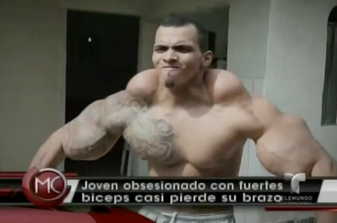 Hombre Obsesionados Con Tener Fuertes Biceps Casi Pierde Sus Brazos #Video