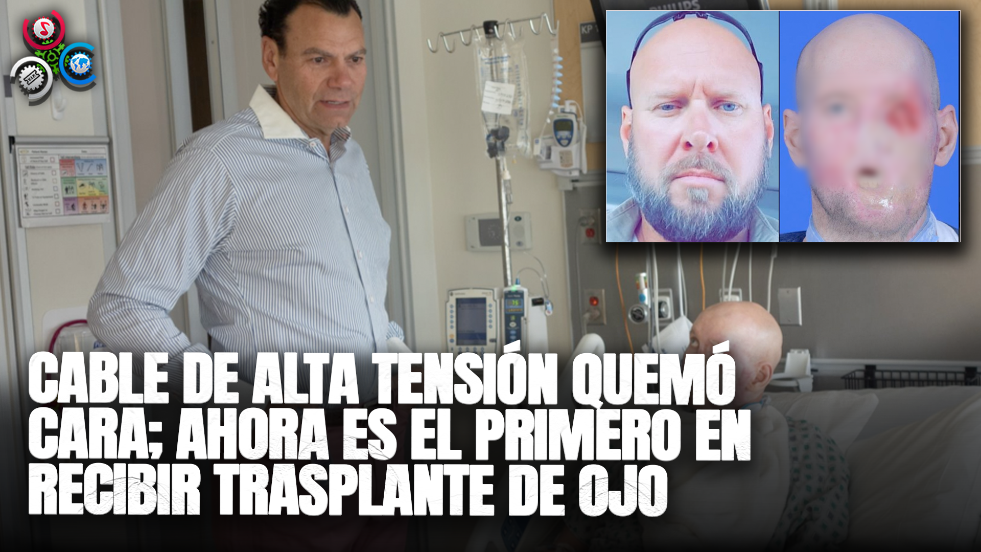 Primer Hombre En Recibir Trasplante De Ojo En Nueva York