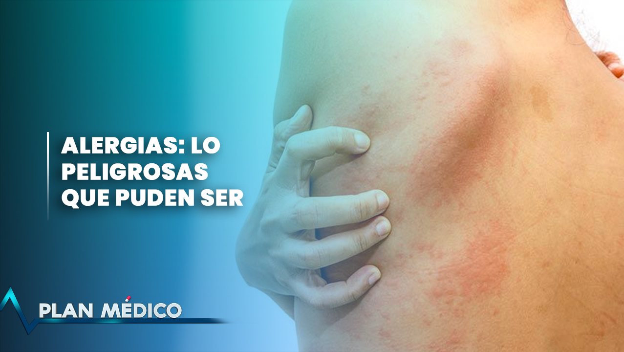 Alergias: Lo Peligrosas Que Pueden Ser | Plan Médico