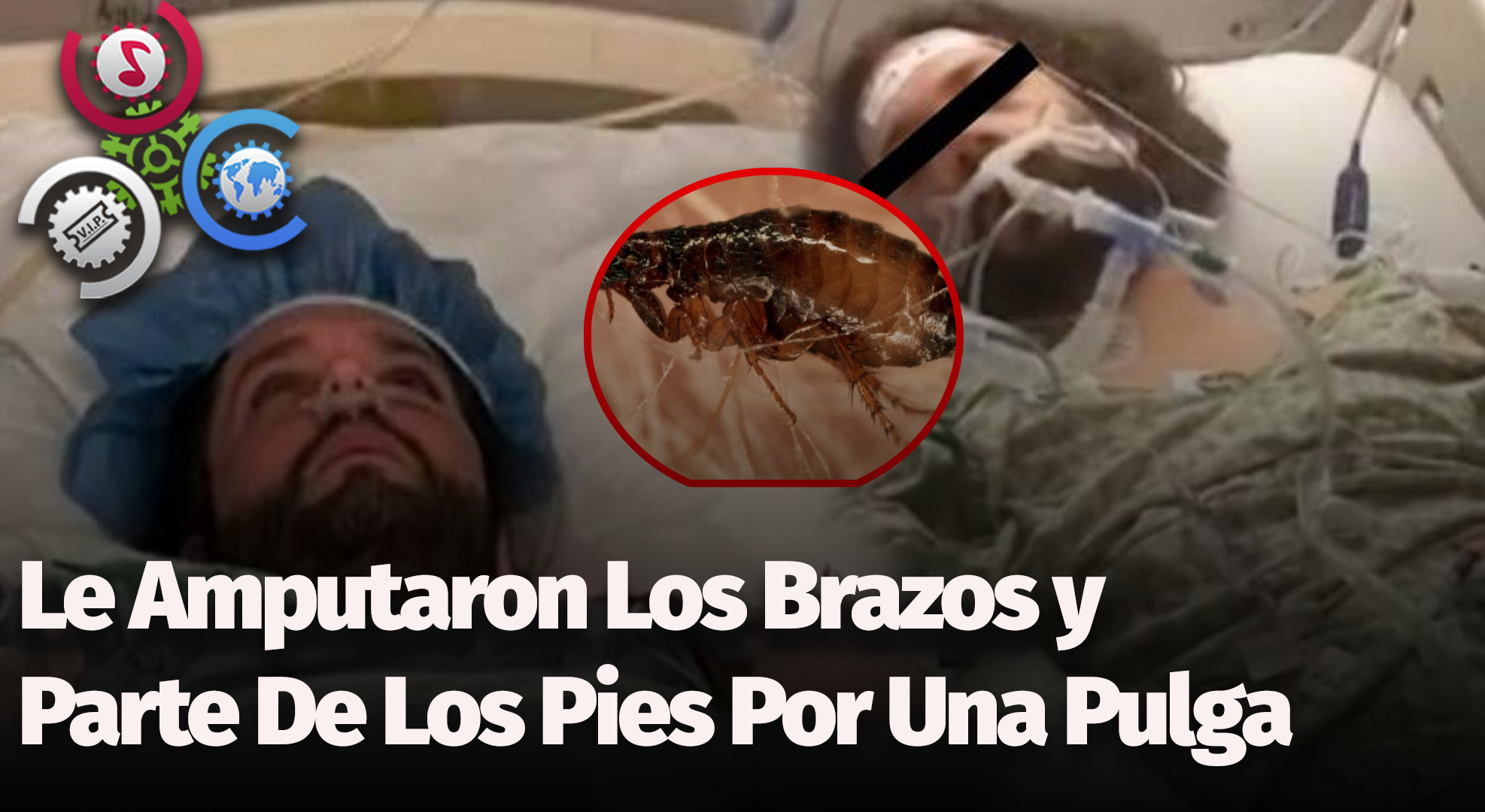 Le Amputaron Los Brazos Y Parte De Los Pies Por Una Pulga