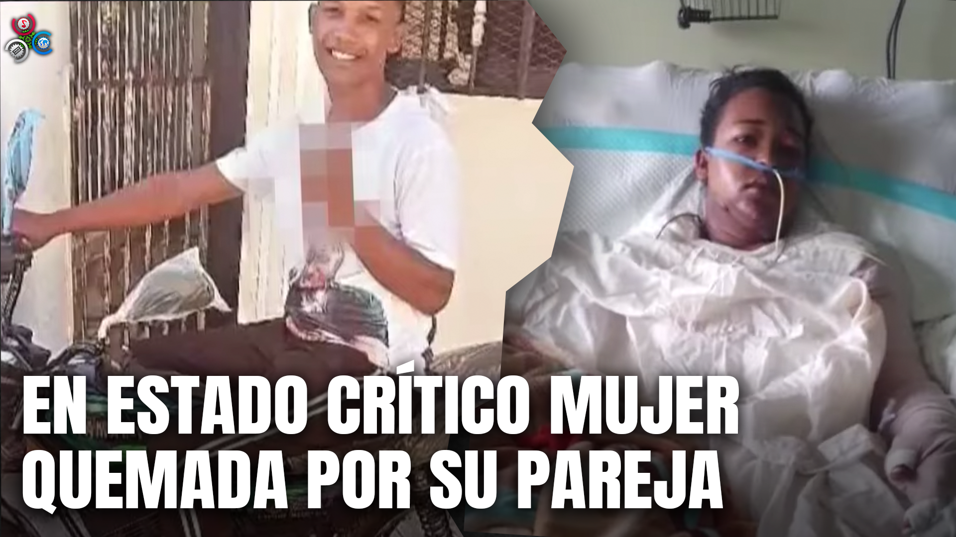 En Estado Delicado Mujer Quemada Por Su Pareja