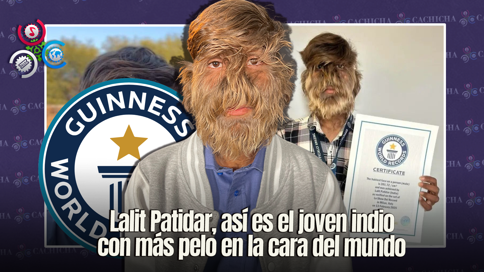 Joven Indio Recibe Récord Guinness Por Tener El Rostro Más Peludo Del Mundo