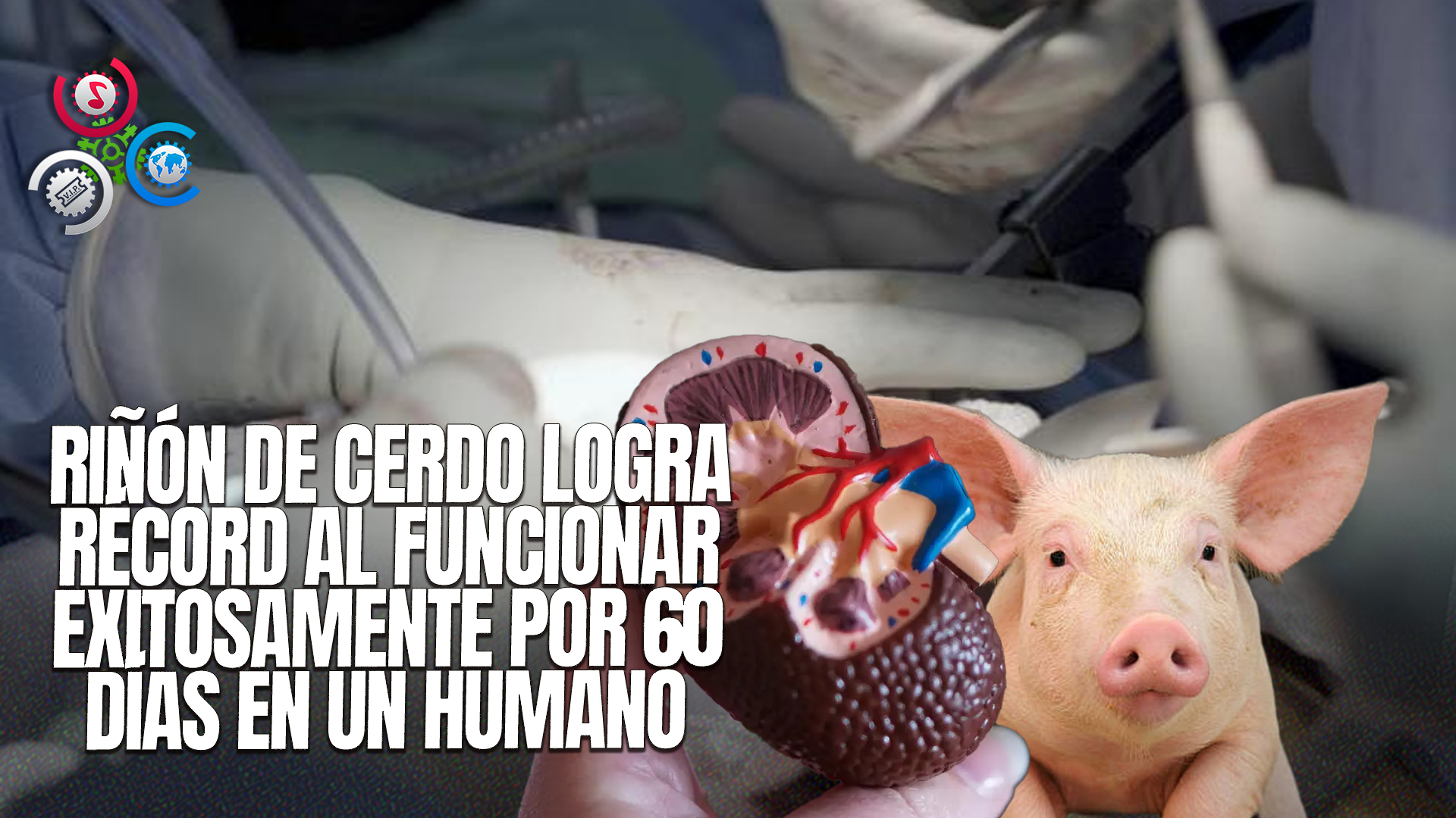 Mujer De Alabama Se Convierte En La Receptora Más Longeva De Un Trasplante De Riñón De Cerdo