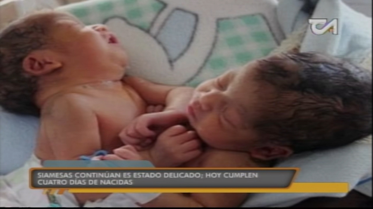 Siamesas Continúan En Estado Delicado; Hoy Cumplen Cuatro Días De Nacidas