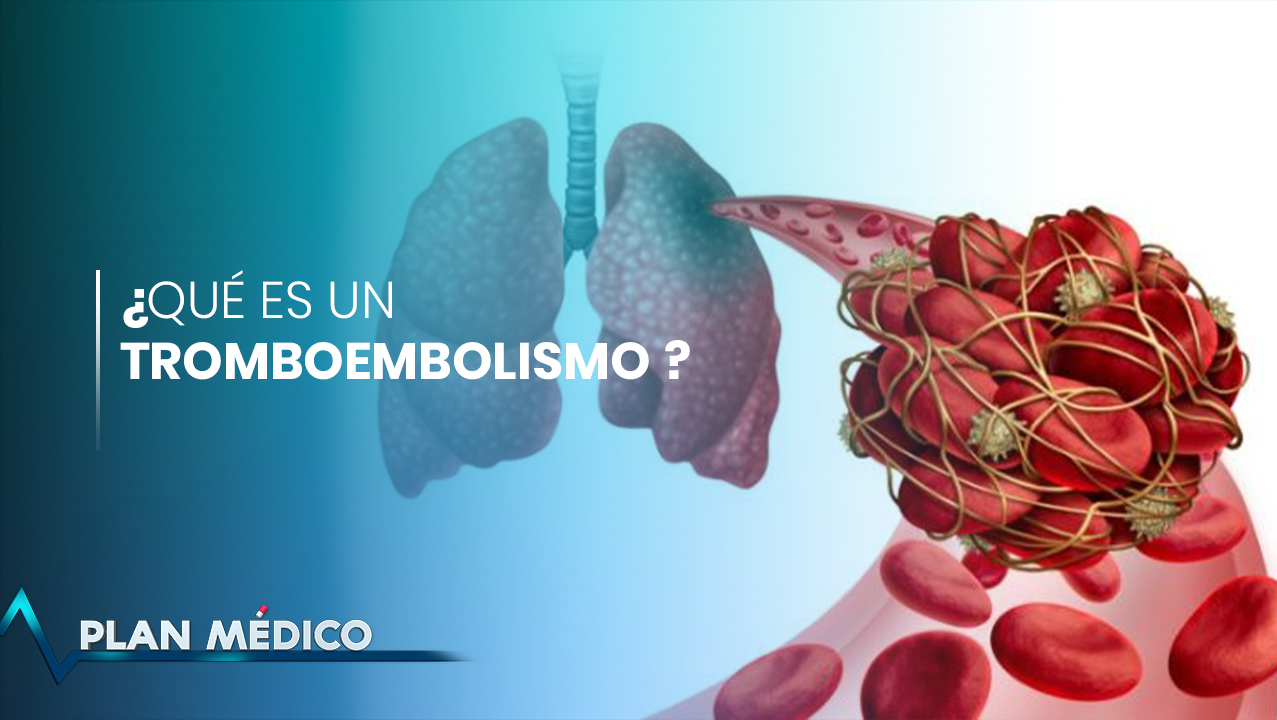 Tromboembolismo: ¿Por Qué Un Coágulo De Sangre Te Puede Matar? | Plan Médico (1/2)
